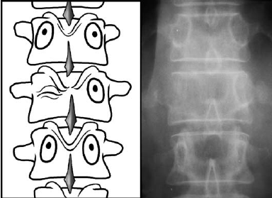 Fig-3-Pedicle-erosion-winking-owl-sign-the-most-common-plain-film-finding-in.png