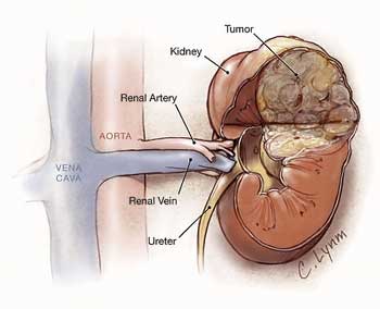 Kidneycaner.jpg