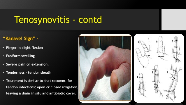 hand-foot-infections-22-638.jpg