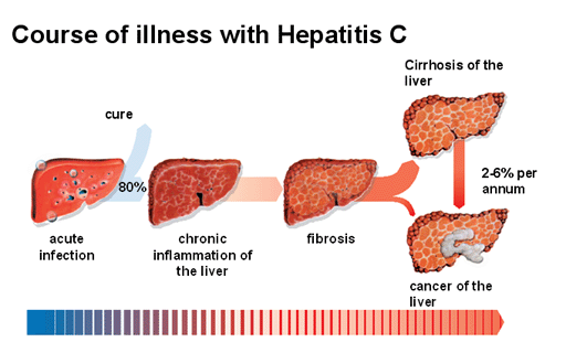 hepatitis-c-infection.gif