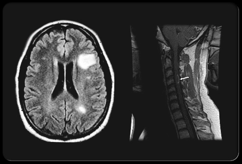 multiple-sclerosis-s13-mri-brain-and-spinal-cord.jpg