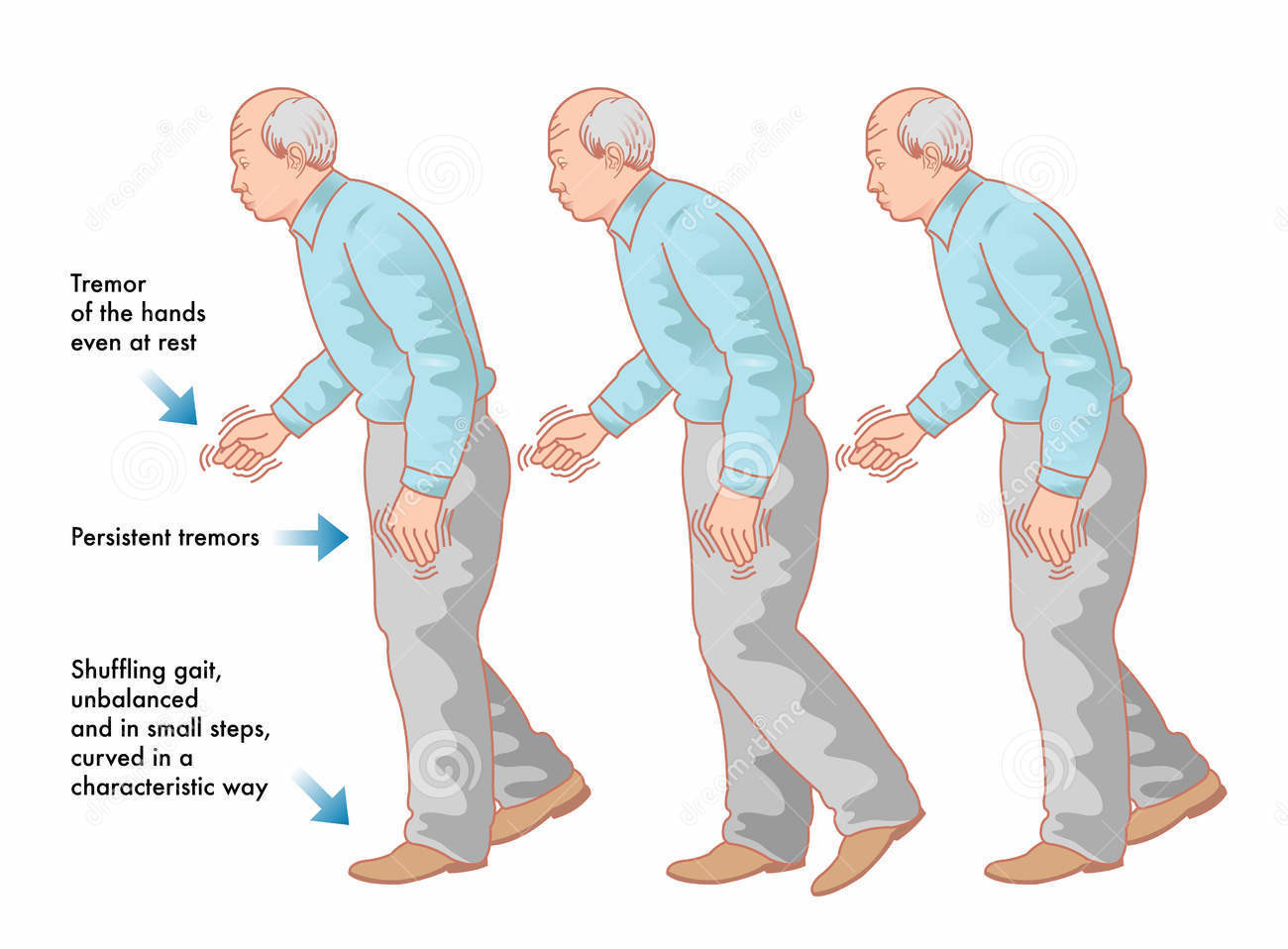 parkinsons-disease-medical-illustration-symptoms-40286638-e1435332141200.jpg