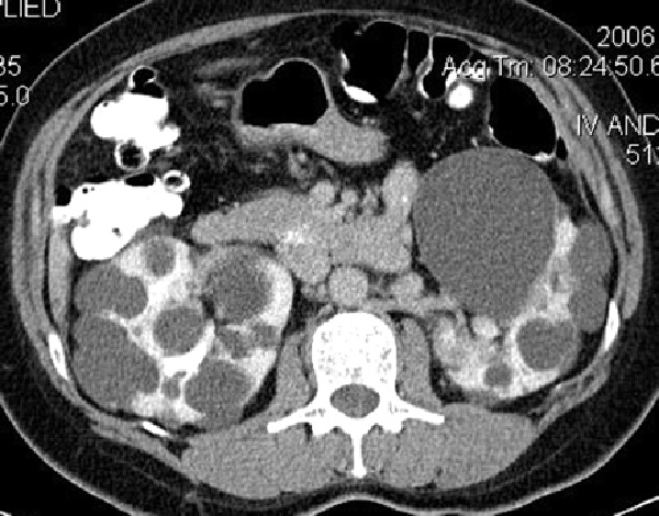 polycystic-kidney-disease-2.gif