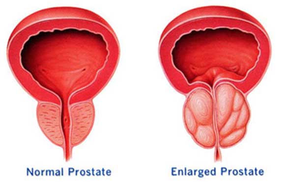 prostata-comparacion.jpg